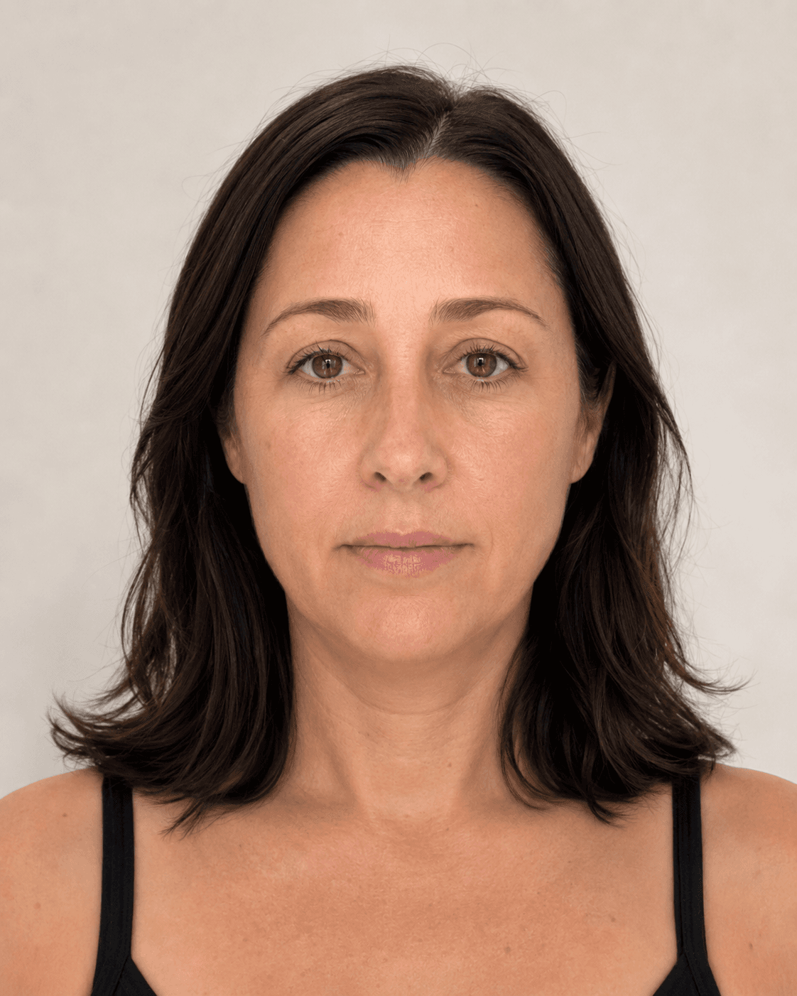 After: Jawline definition & lift after 8 weeks
