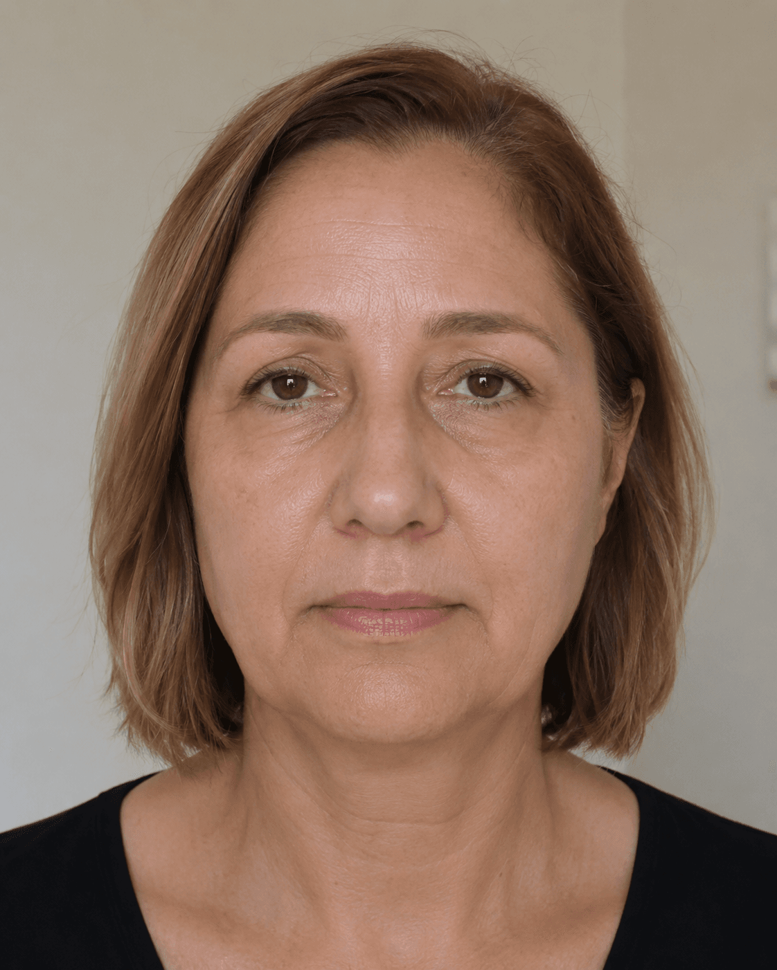 Before: Full-face lift & radiance after 10 weeks